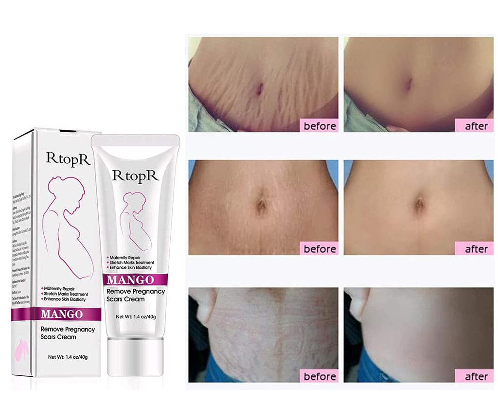Rtopr Mango Stretch Marks and Scar Cream -Stretch Marks and Scar Removal Cream for Pregnancy - Best Body Moisturizer-40G New Holicare`s deal