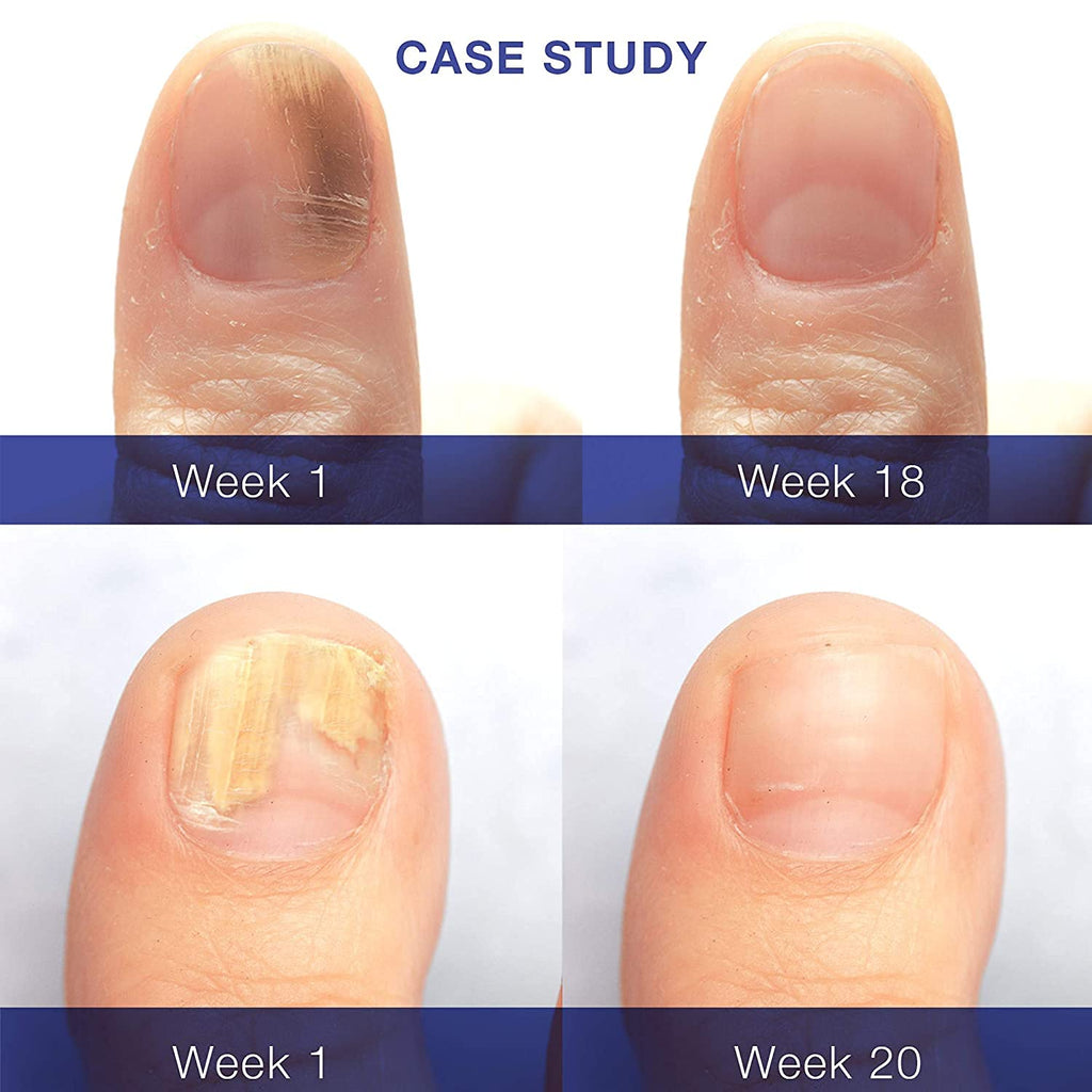 10/50ml Foot Nail Care Essence Whitening Toe Nail Toe Nail Fungus Removal  Gel | eBay