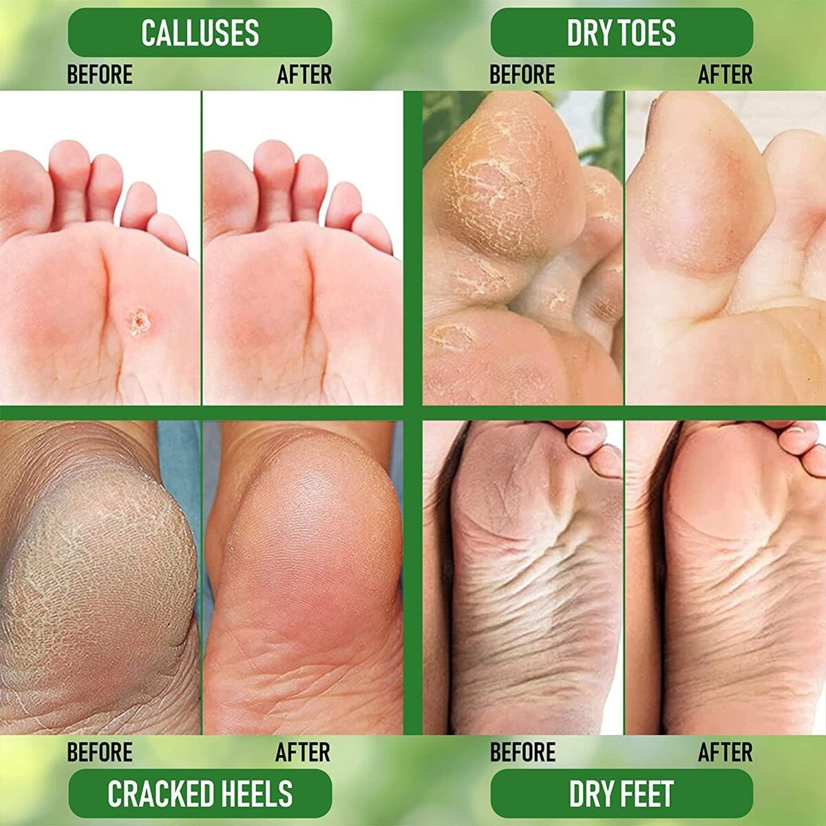 "Revitalize and Renew Your Feet with Purorganica Urea 40% Foot Cream - Made in USA - Say Goodbye to Corns, Calluses, and Dead Skin - Ultimate Moisturizer and Rehydrater for Thick, Cracked, Rough, and Dry Skin - Perfect for Feet, Elbows, and Hands"