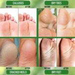 "Revitalize and Renew Your Feet with Purorganica Urea 40% Foot Cream - Made in USA - Say Goodbye to Corns, Calluses, and Dead Skin - Ultimate Moisturizer and Rehydrater for Thick, Cracked, Rough, and Dry Skin - Perfect for Feet, Elbows, and Hands"