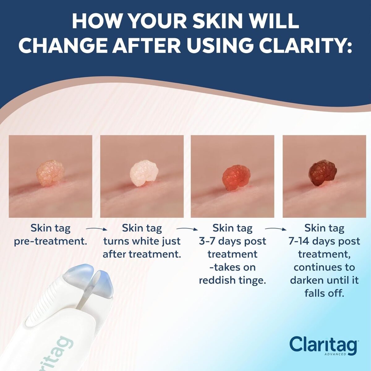 Advanced Skin Tag Remover - Fda-Cleared Device - Only for Skin Tag Removal - Works in 7-14 Days - up to 10 Treatment Cycles - Cryogenic Freeze-Off Kit