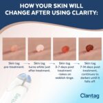 Advanced Skin Tag Remover - Fda-Cleared Device - Only for Skin Tag Removal - Works in 7-14 Days - up to 10 Treatment Cycles - Cryogenic Freeze-Off Kit