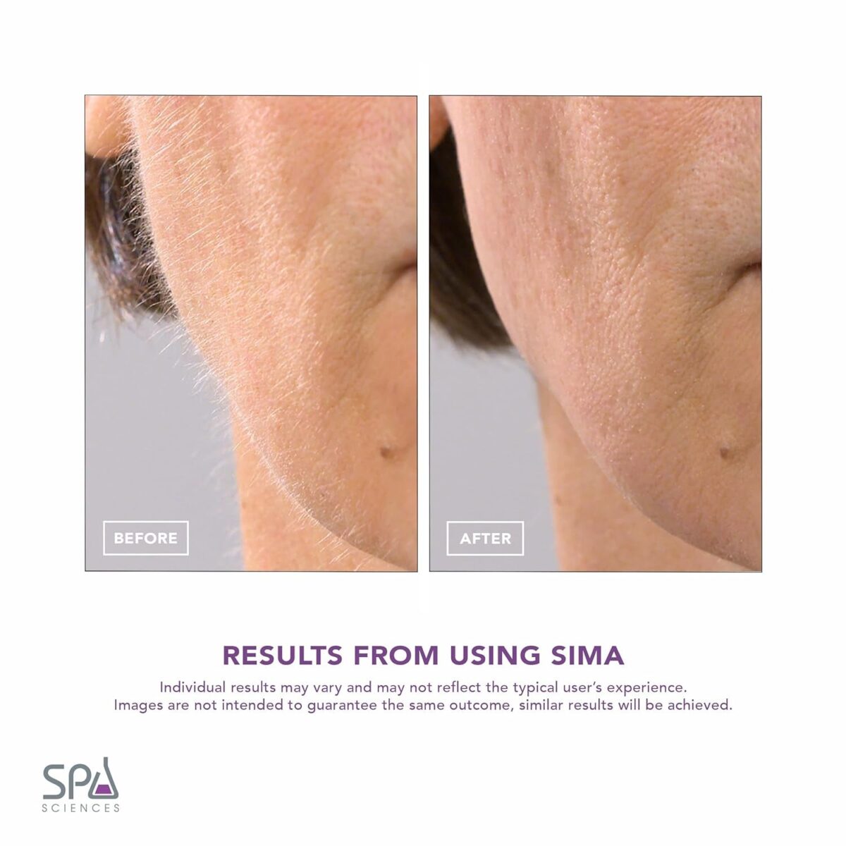 SPA SCIENCES - SIMA Sonic Dermaplaning Tool - Patented Painless 2 in 1 Facial Exfoliation & Peach Fuzz-Hair Removal System W/ 7 Weeks Treatment Included - Anti-Aging – 3 Speeds – Rechargeable